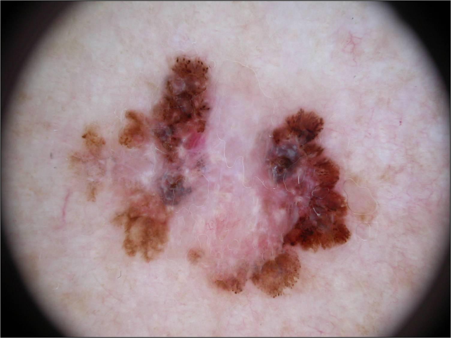Dermatoscopisch voorbeeldbeeld van een gepigmenteerde huidafwijking